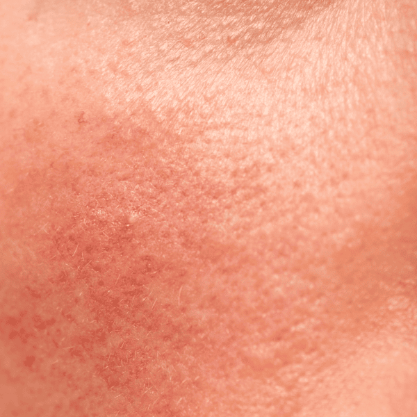 Rosacea