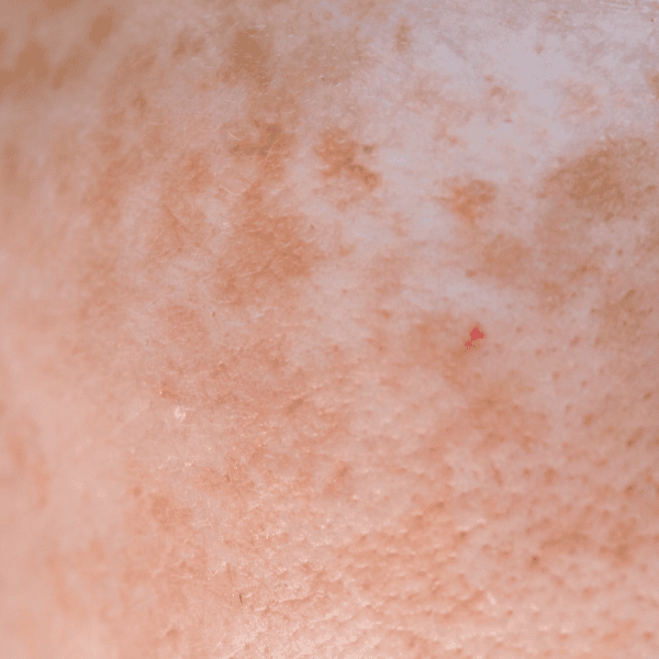 Hyperpigmentation