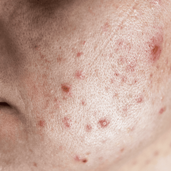 Skin Concerns - Acne