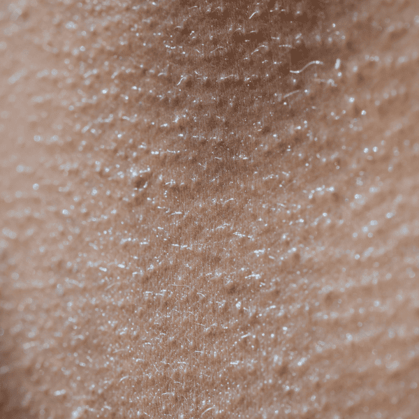 Dullness dehydrated Skin
