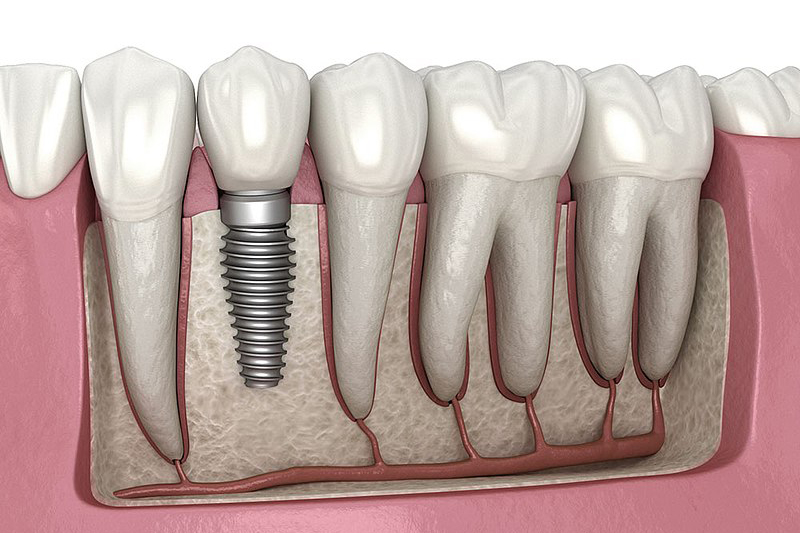 Missing Teeth – Implant